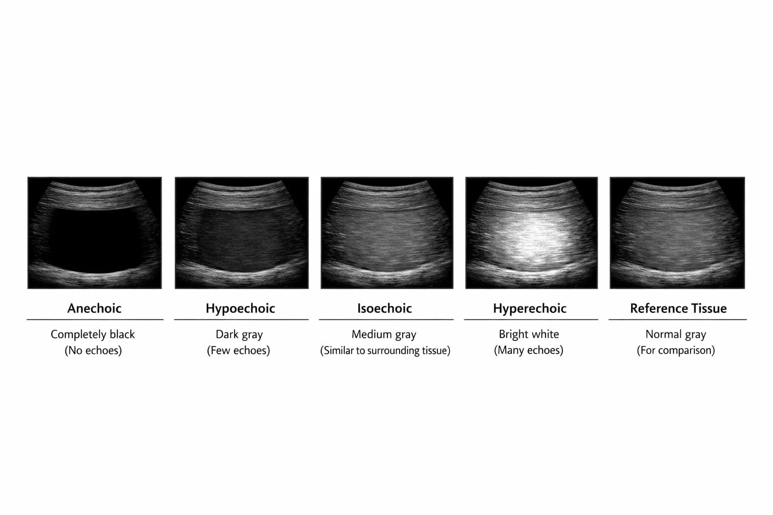Echogenicity – comparison of brightness levels