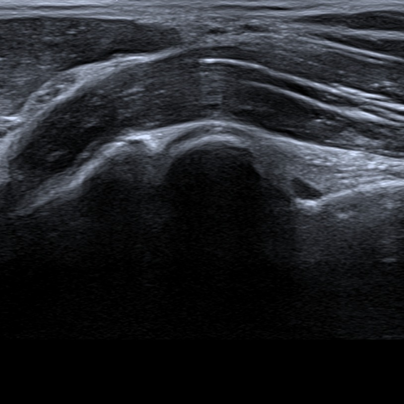 Musculoskeletl ultrasound