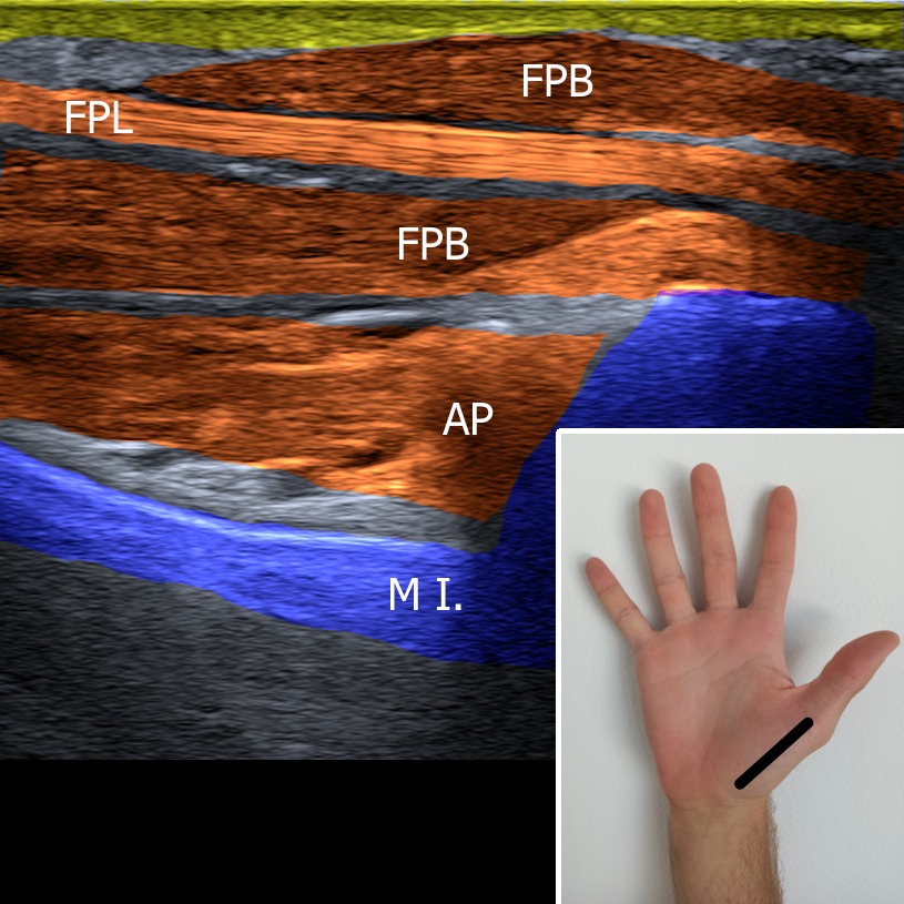 Musculoskeletal ultrasonography