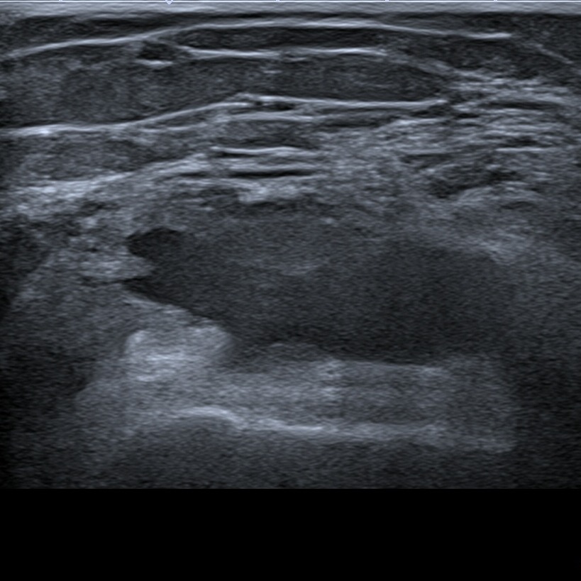 Knee joint effusion