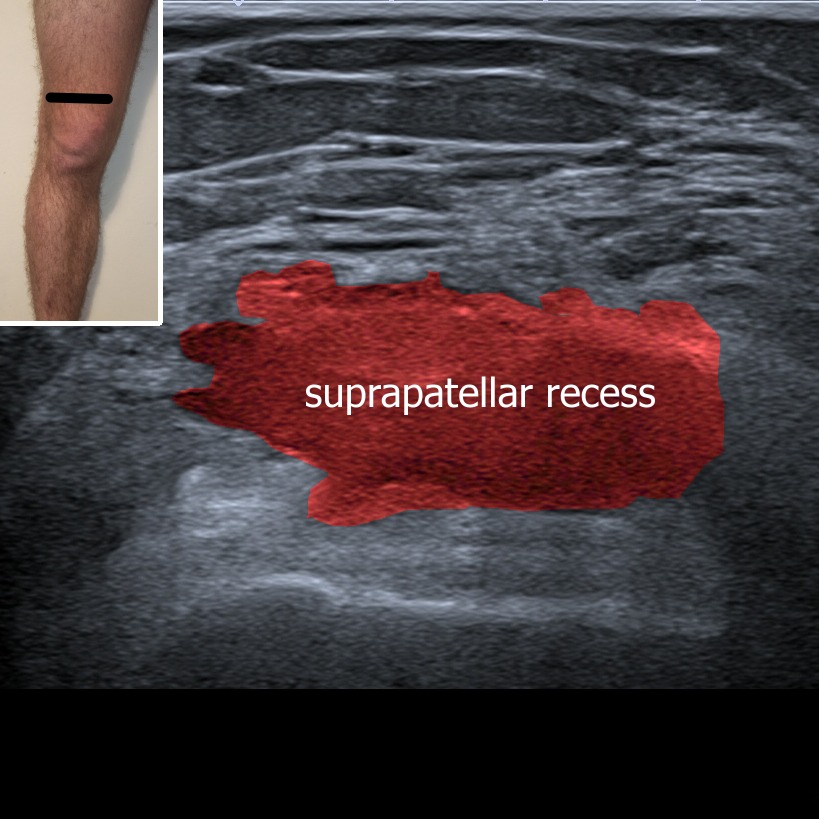 Knee joint effusion