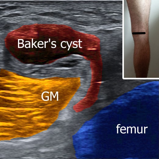 Baker's cyst