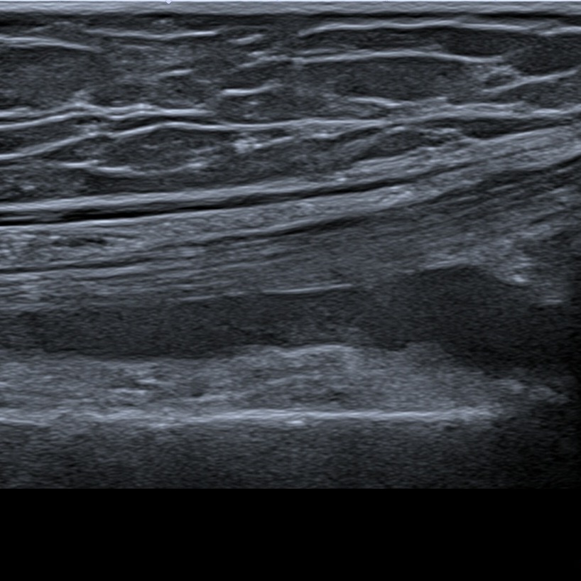 Knee joint effusion