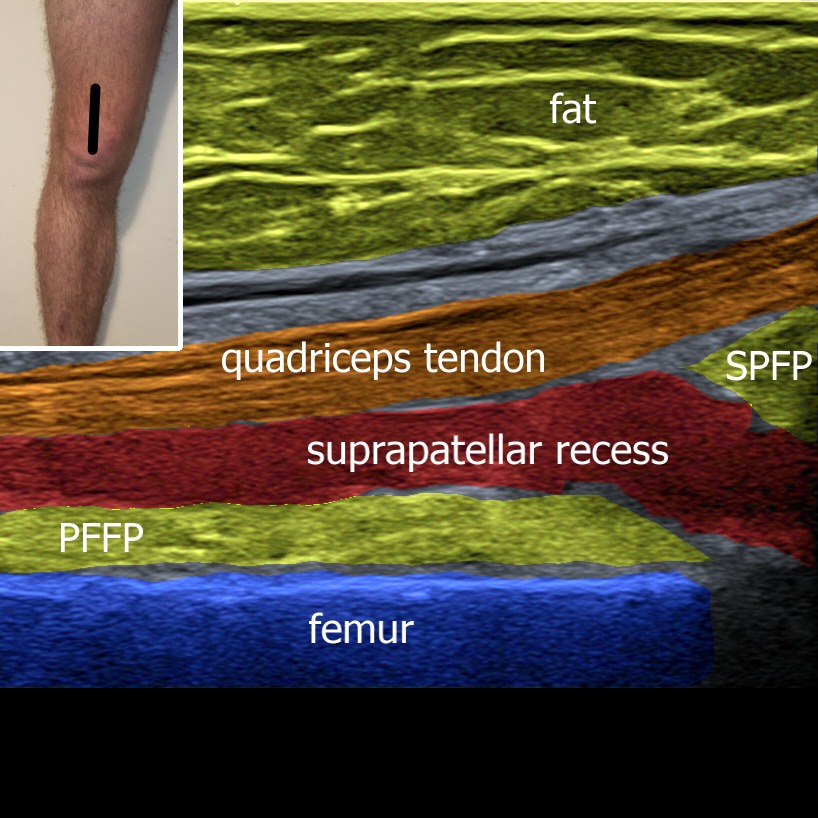 Knee joint effusion