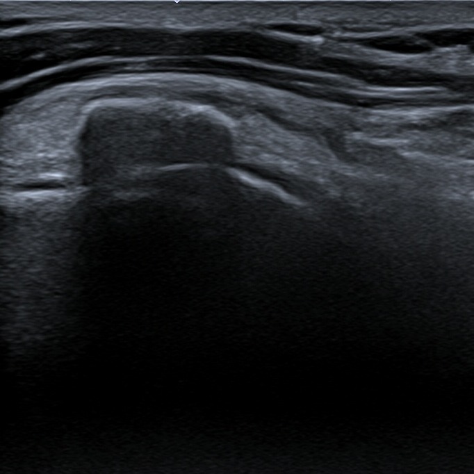 Supraspinatus calcification