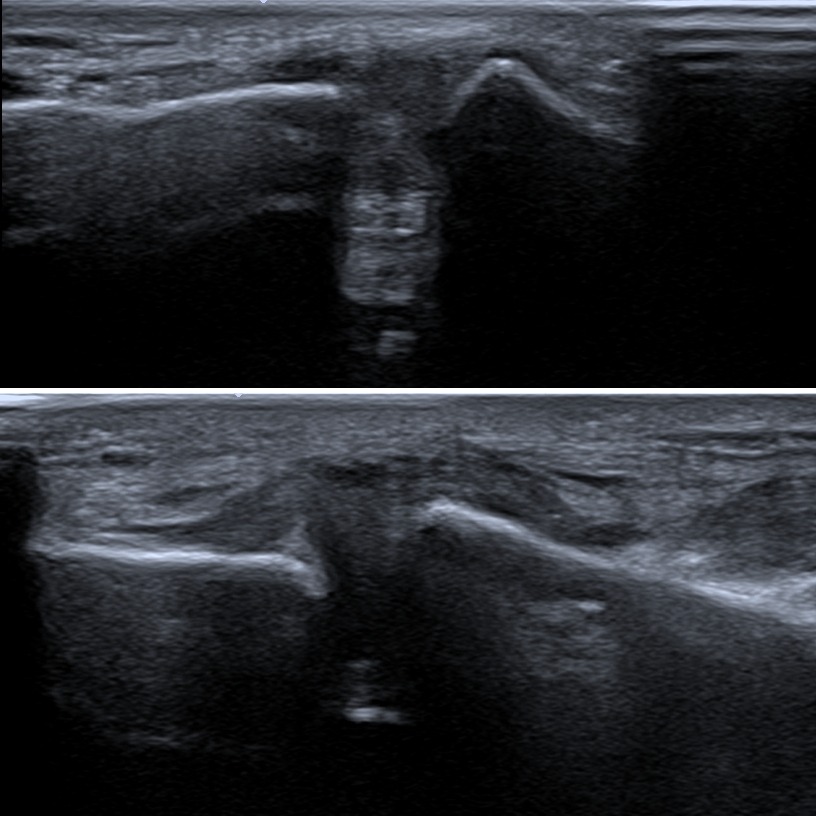 AC joint effusion