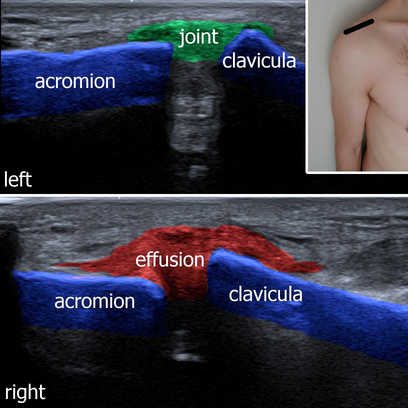 AC_joint effusion