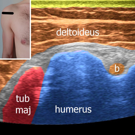 Tuberculum majus fracture